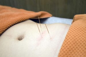 Acupunctura: tratament alternativ
